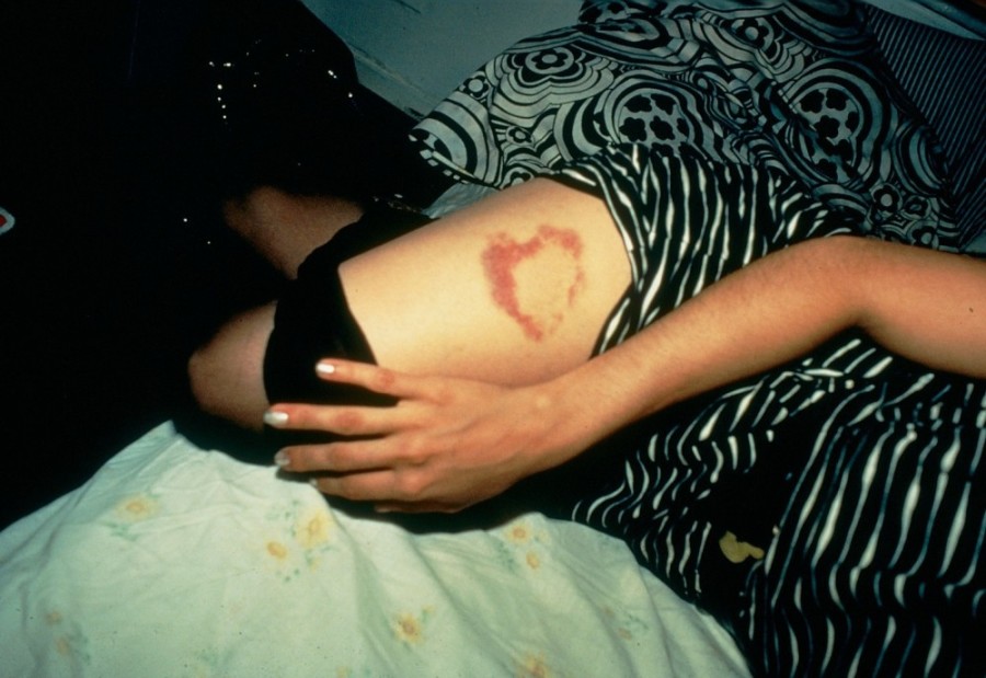 Nan-goldin-heart-shaped-bruise-nyc-1980